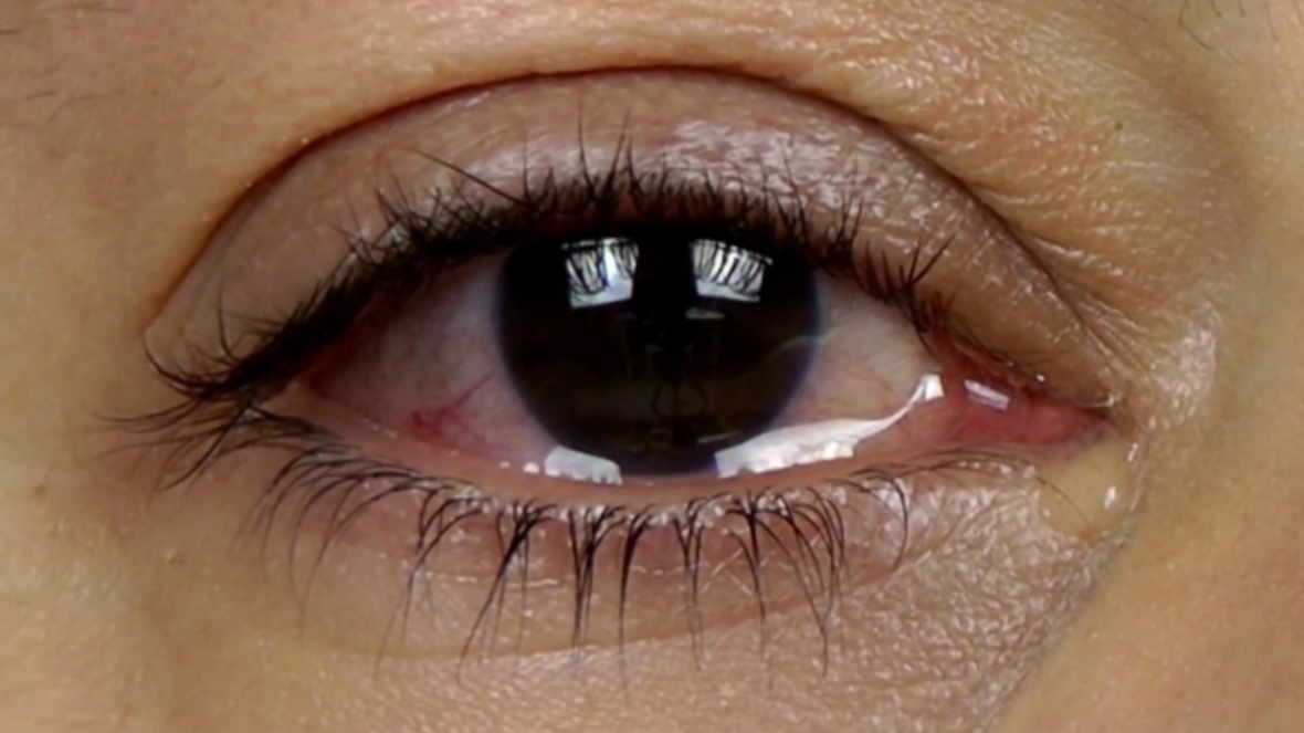 10 درمان خانگی برای کاهش تورم چشم بعد از گریه