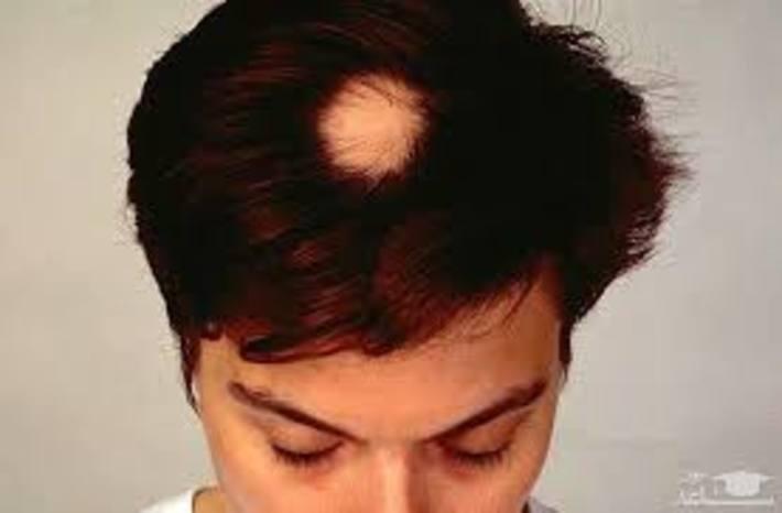 علت ریزش موی سکه ای و راه درمان آن چیست ؟ علت ریزش موی سکه ای و راه درمان آن چیست ؟
