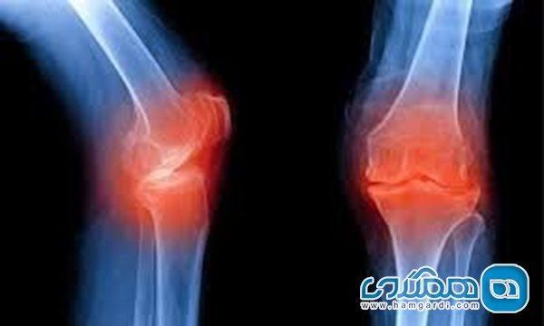 راهکارهایی برای پیشگیری از بروز آرتروز