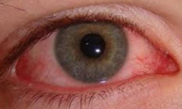 سوختگی شیمیایی چشم در یک نگاه